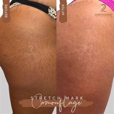 Stretch Mark Tattoo Camouflage: A Stylish Solution for Sensitive Skin